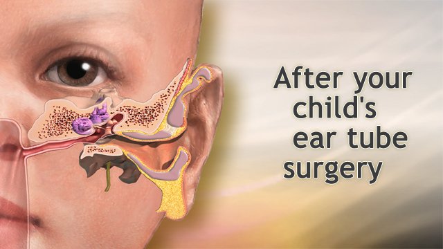 3 Ear Tubes Surgery