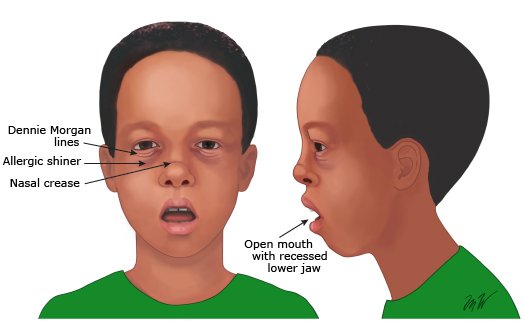 Adenoidectomy Children Singapore