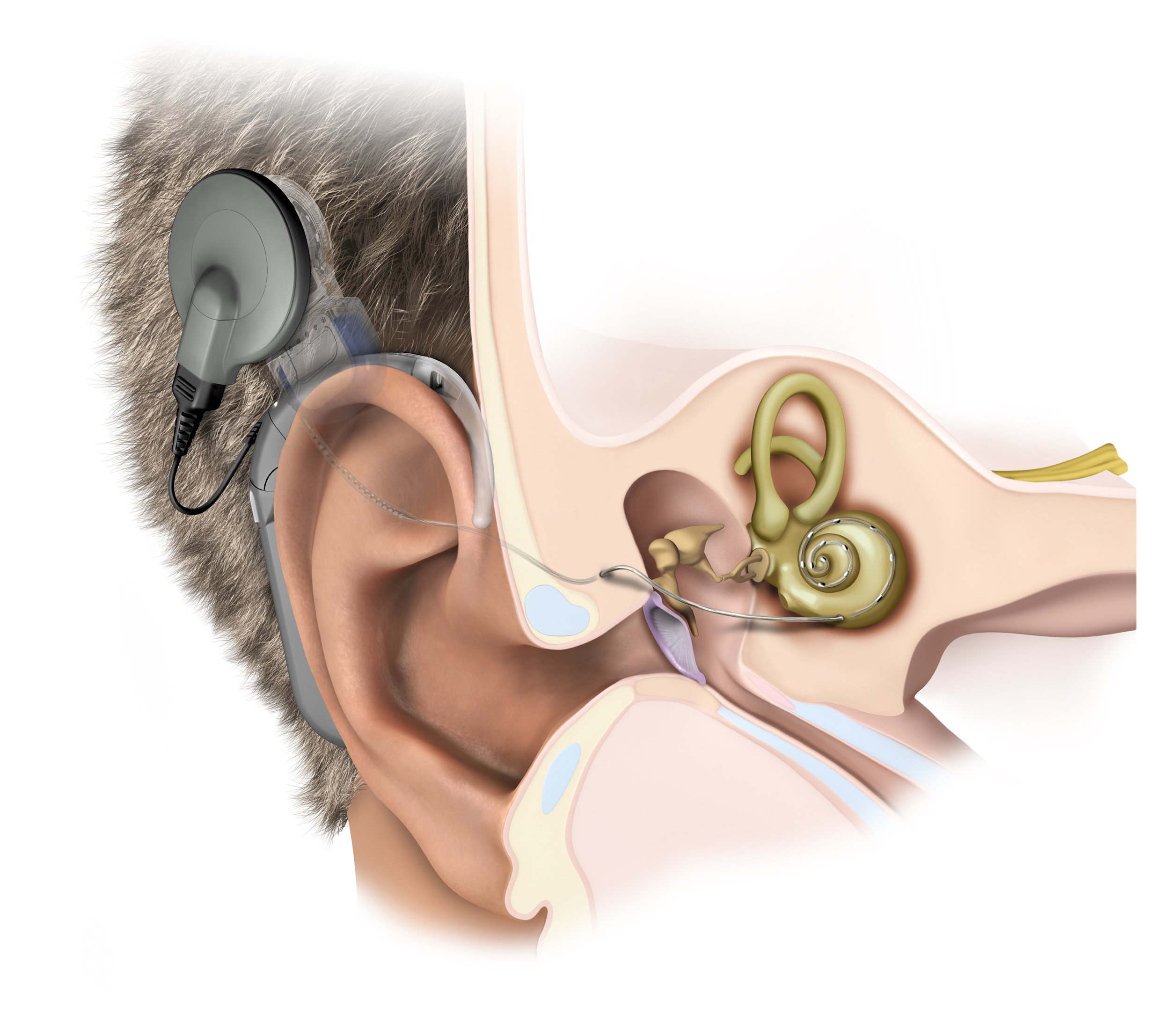 Auditory Brainstem and Cochlear Implants