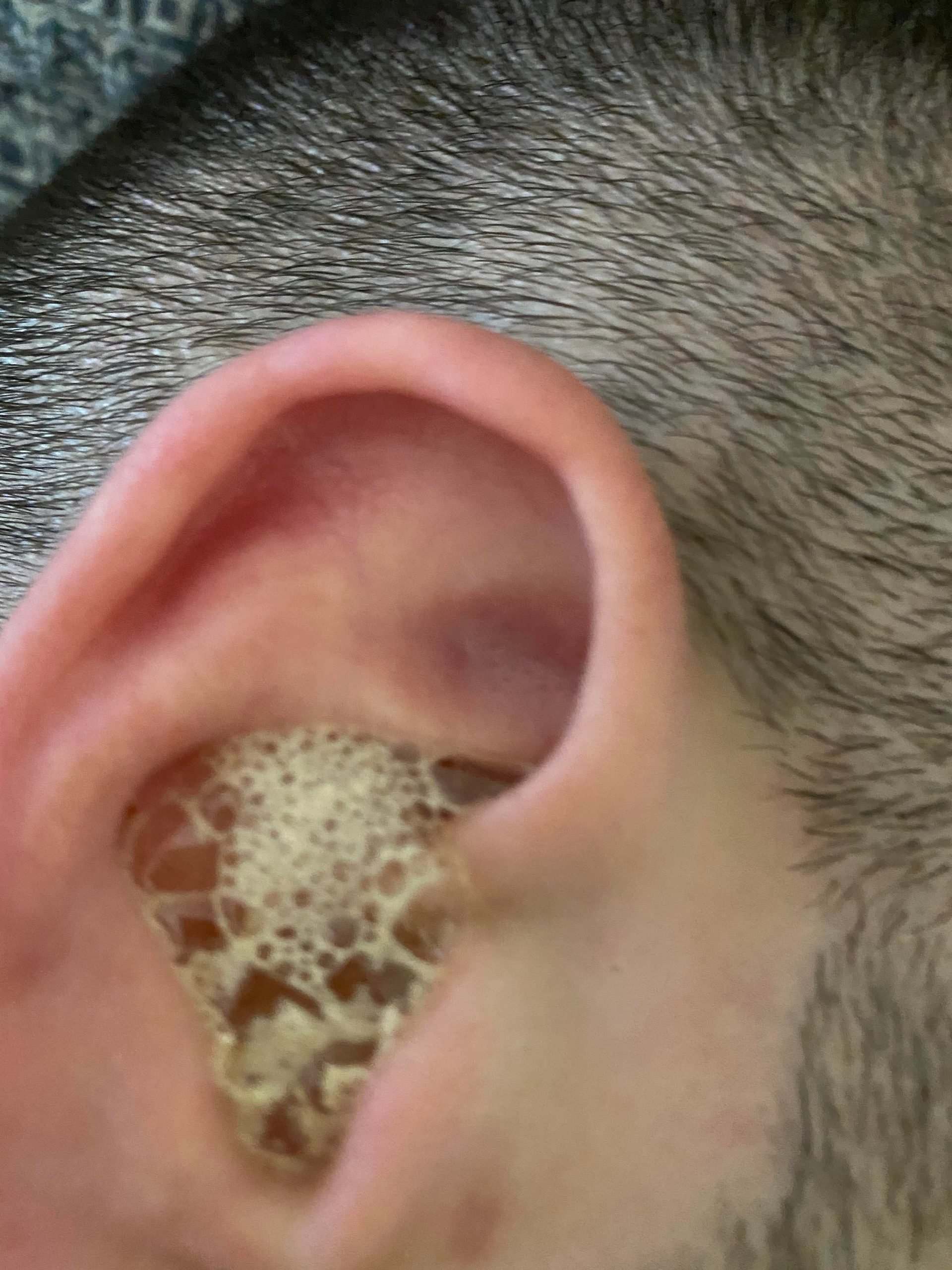 Blocked ear + Peroxide : earwax