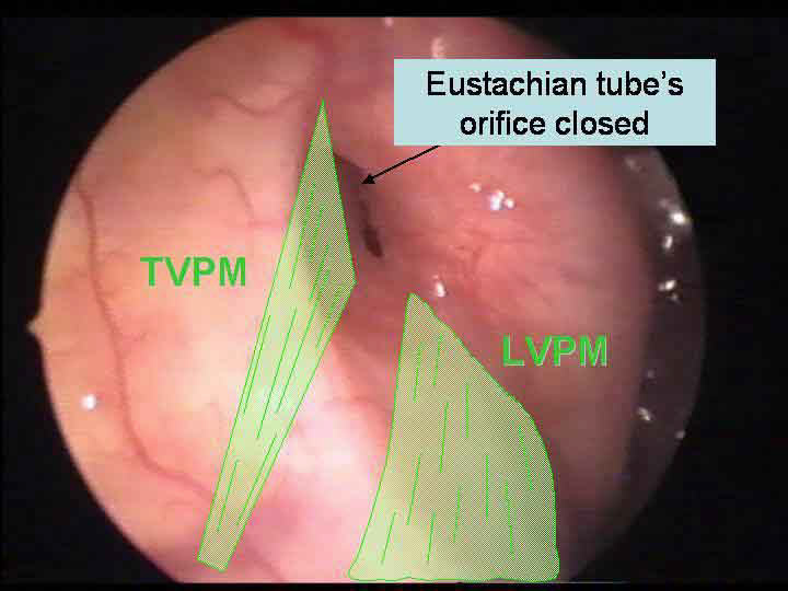 Blocked Eustachian Tubes