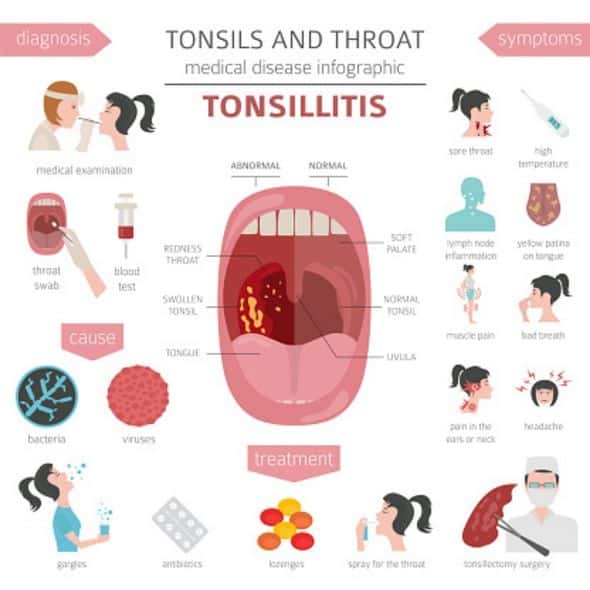 Can you catch tonsillitis? Signs and symptoms of infection explained ...