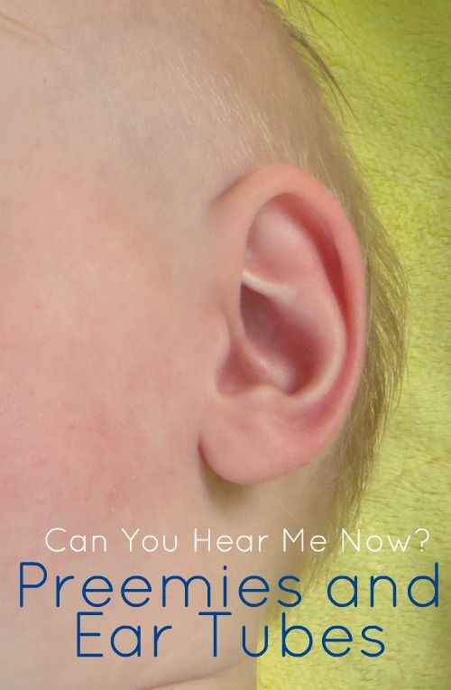 Can You Hear Me Now? Preemies and Ear Tubes
