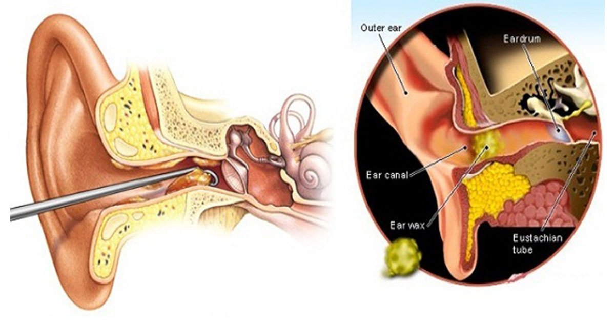 Causes for Ear Wax Buildup and How to Remove It At Home ...
