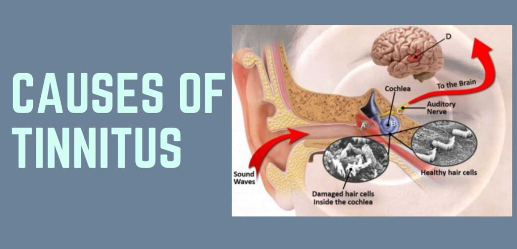 Causes Of Tinnitus
