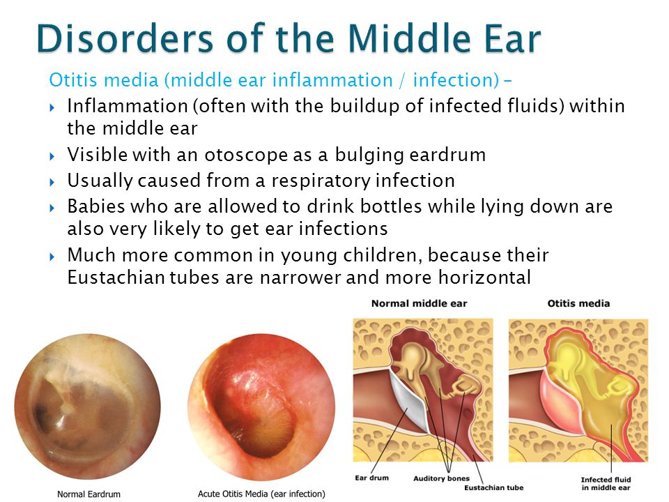 Childhood Diseases  On a Mission to Educate: Ear Infections  Steemit