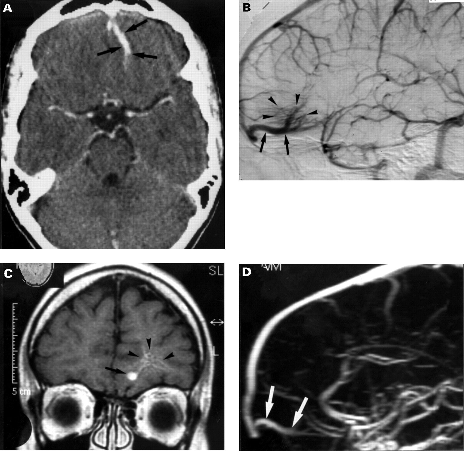 Clinical significance of intracranial developmental venous ...