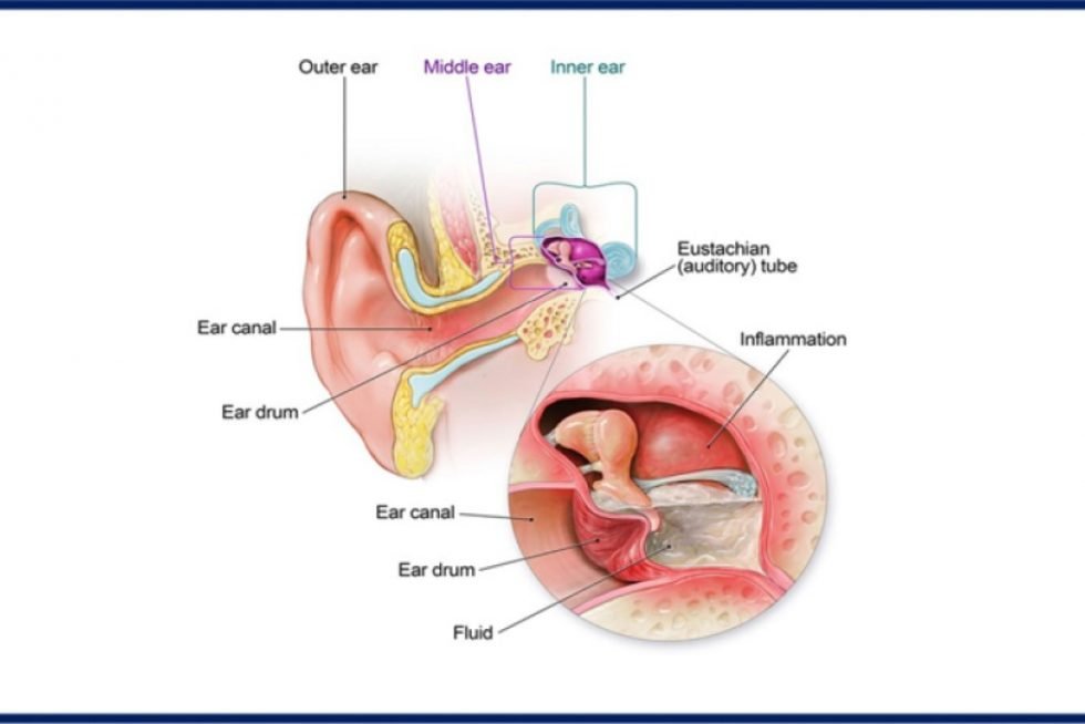 Clinicians Use Artificial Intelligence to Diagnose Ear ...