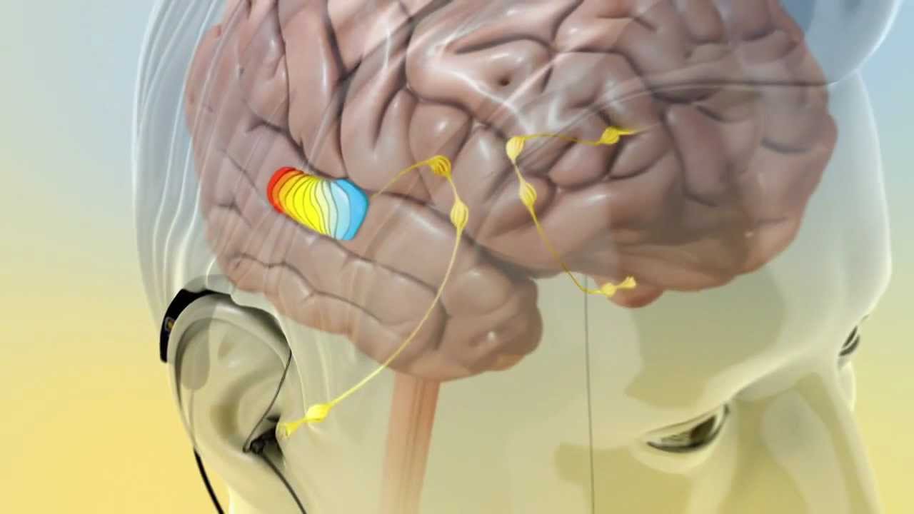 Conditions  Tinnitus  NeuroSpa Brain Rejuvenation Center