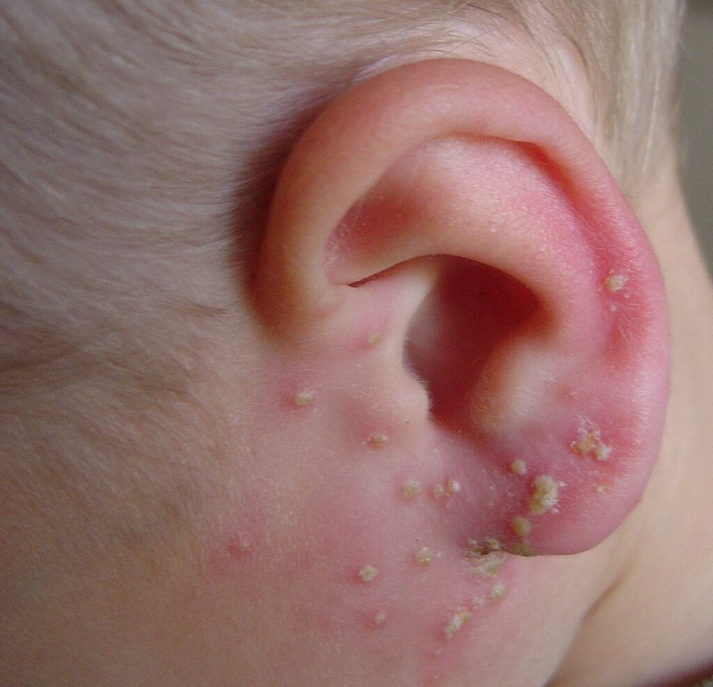 Crusty Behind Ears Causes, Symptoms, Dry Skin, Psoriasis, Skin ...