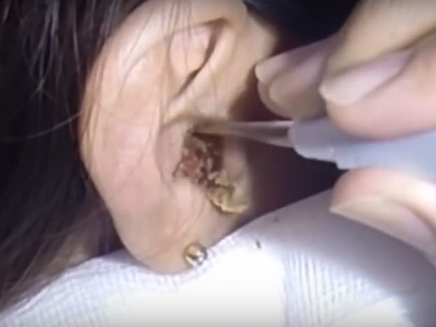 Disgusting Moment Huge Amount Of Earwax Is Pulled From ...