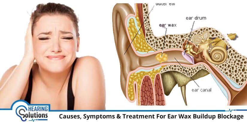 Do Excessive Ear Wax Causes Hearing Loss? What are the ...