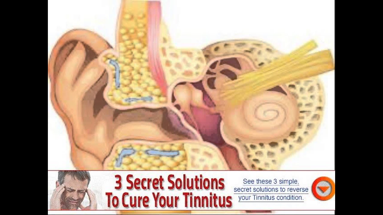 do it yourself tinnitus retraining therapy