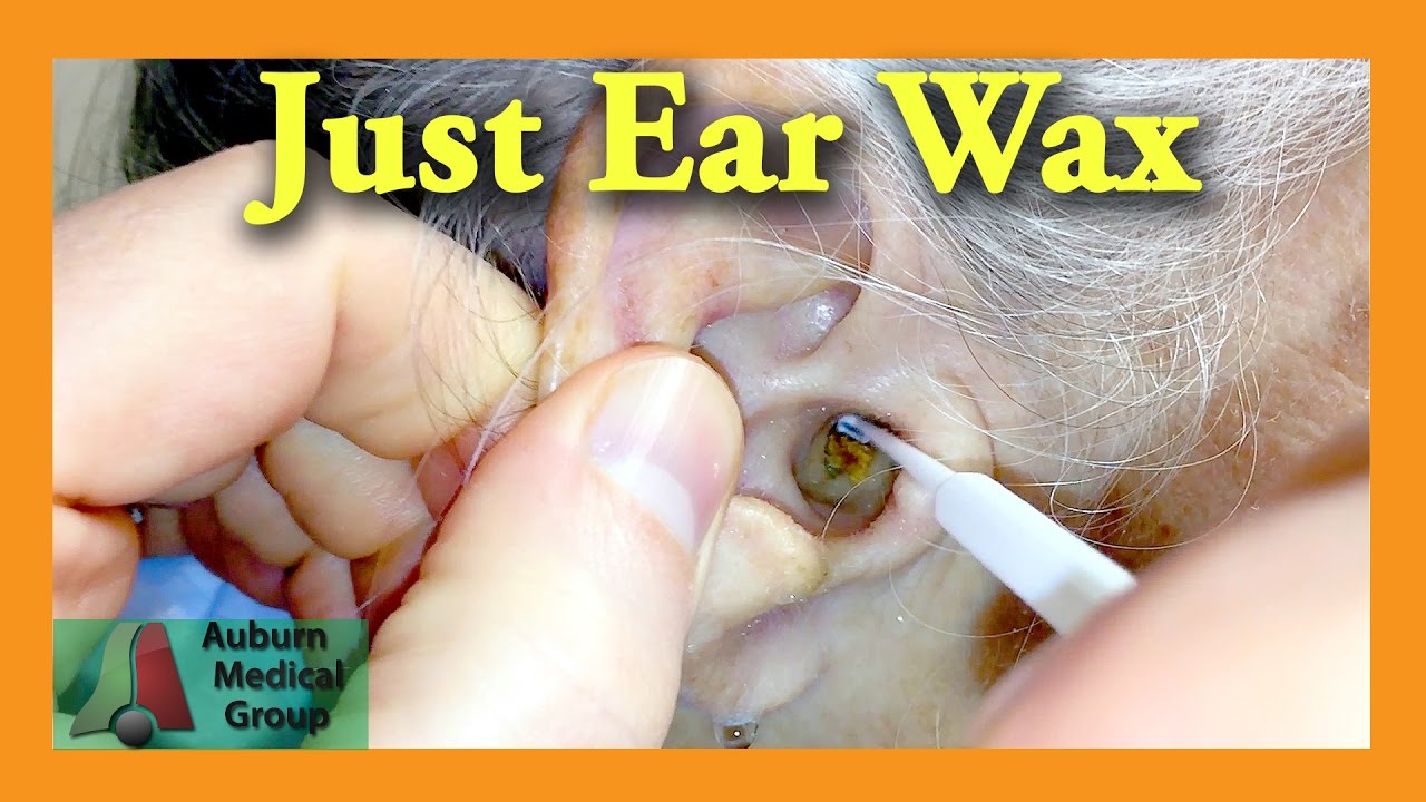 Doctor Ear Wax Removal