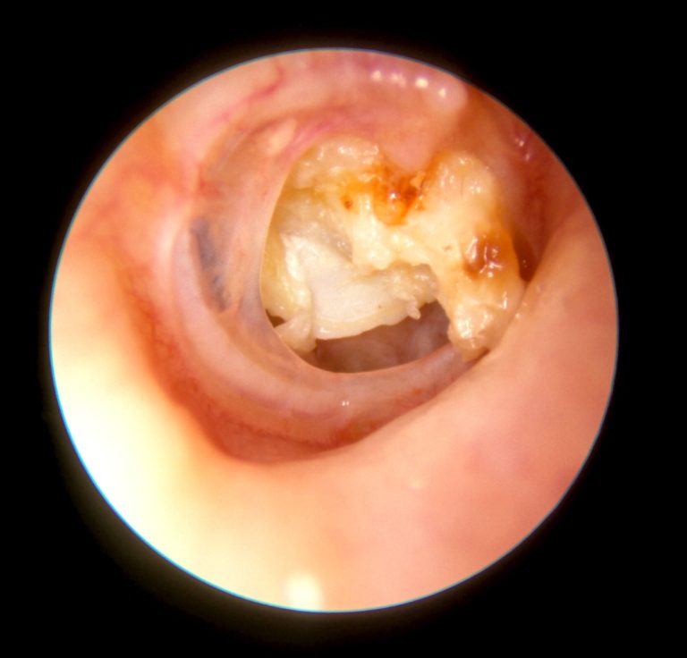 Ear Discharge: Ear infection?