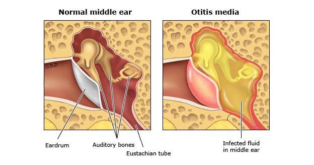 Ear infections: Symptoms and Treatment