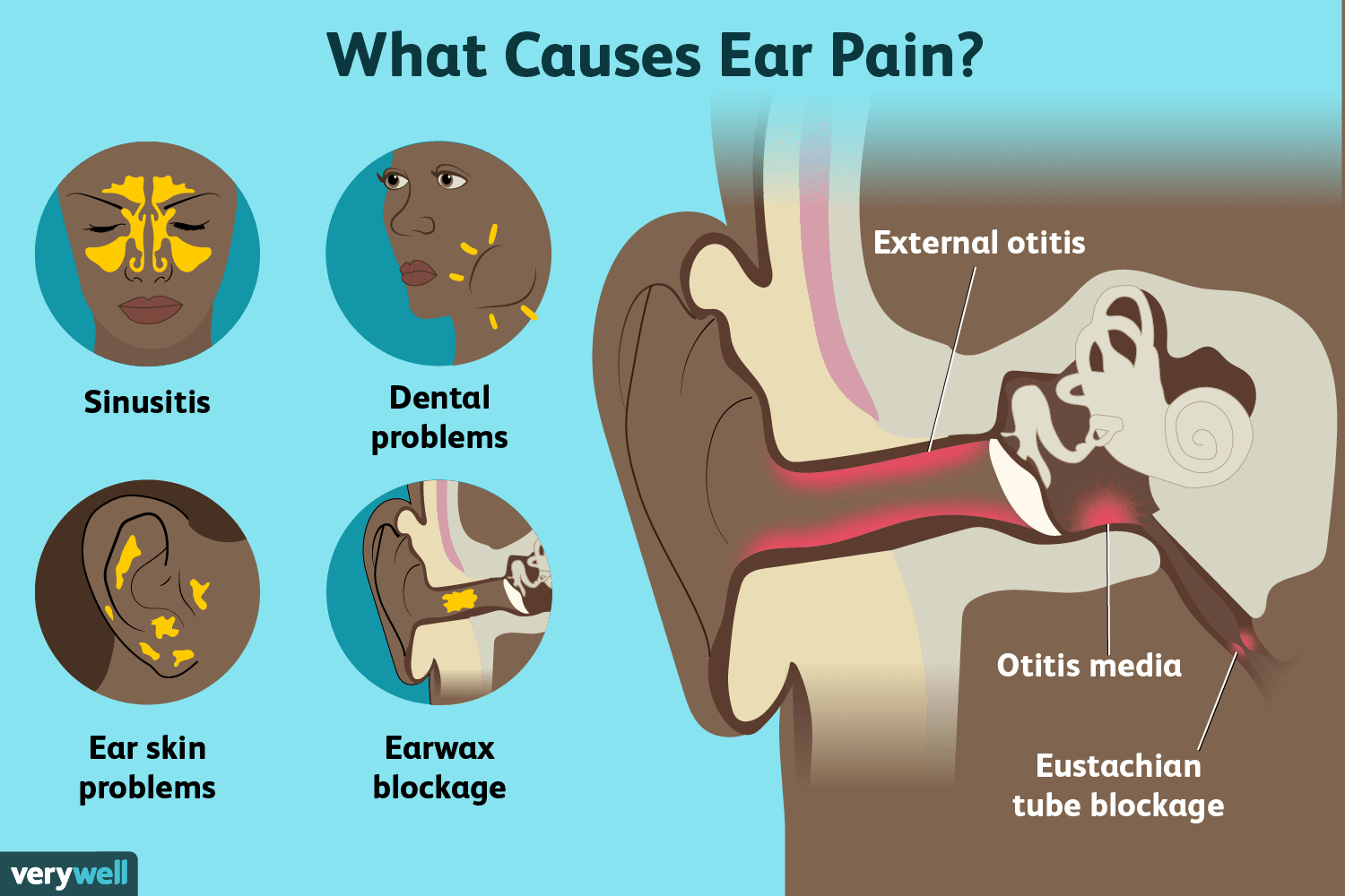 Ear Pain: Types, Causes, Treatment, and Prevention