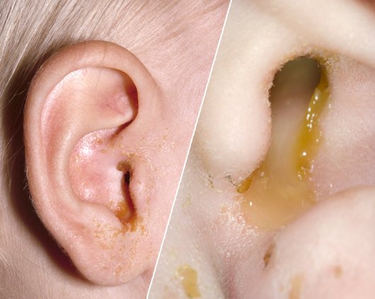 Ear Tube Drainage from Middle Ear Infection