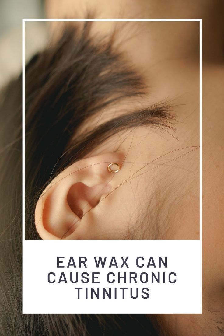 Ear Wax Can Cause Chronic Tinnitus  How To Remove Ear Wax ...