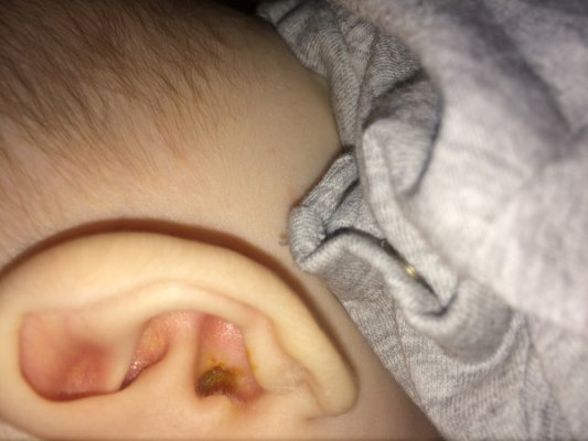 Ear wax issue ?