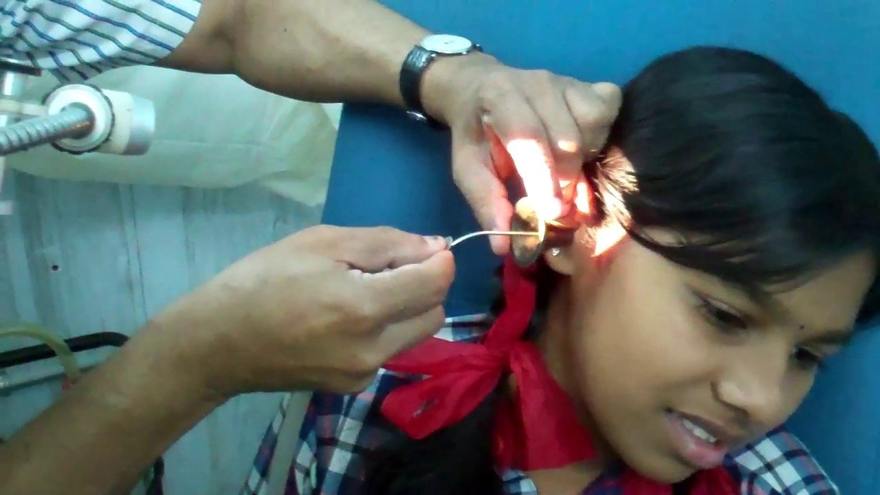 Ear Wax Removal by Suction Cleaning