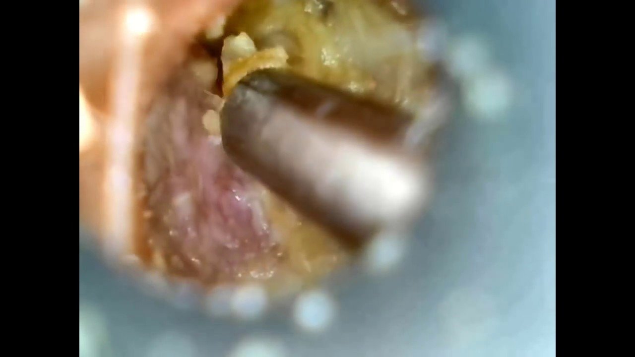 Ear wax removal on exostoses (swimmer