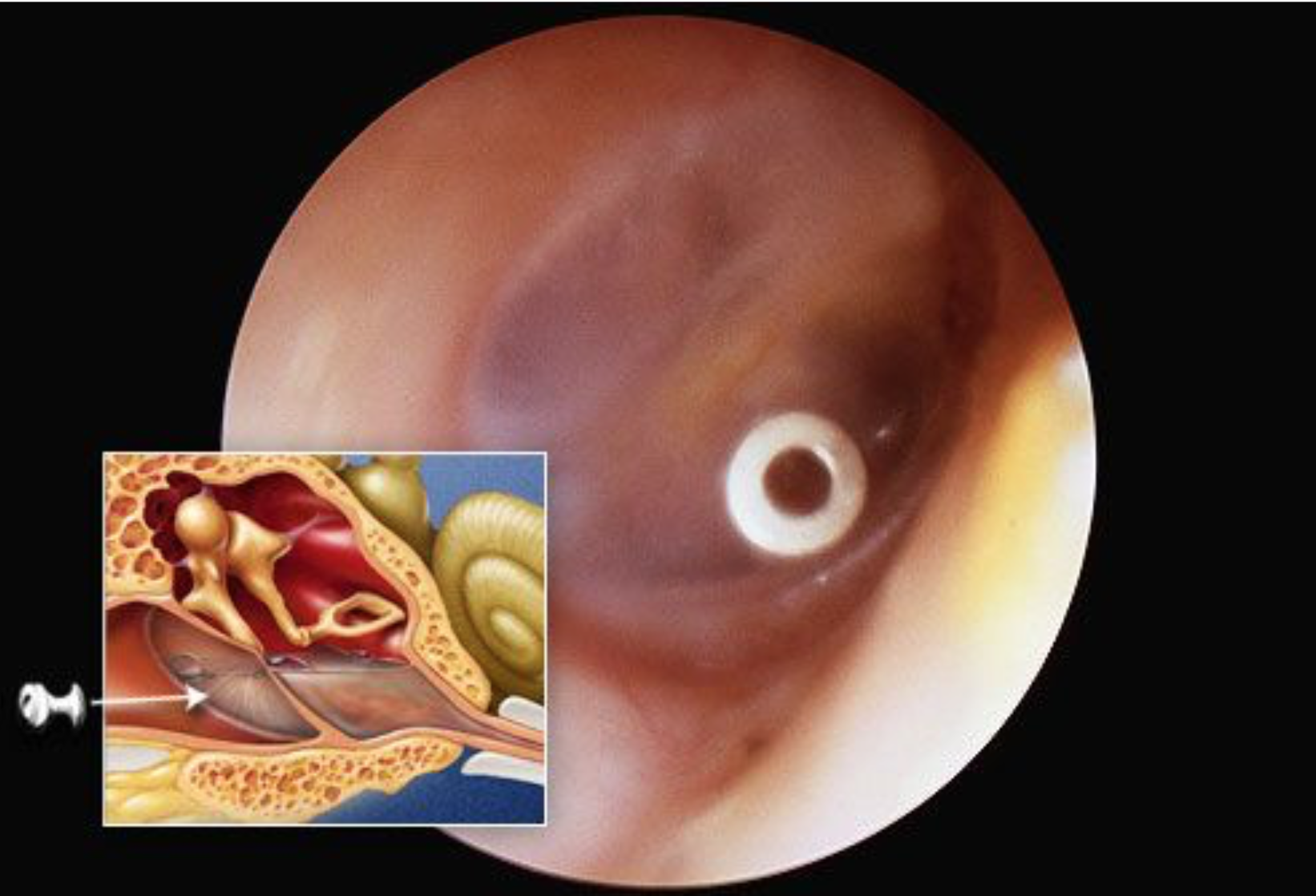 Fluid behind eardrum and dizziness