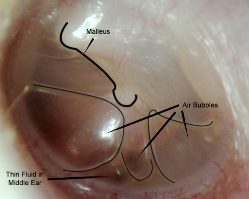 Fluid in the ear Images
