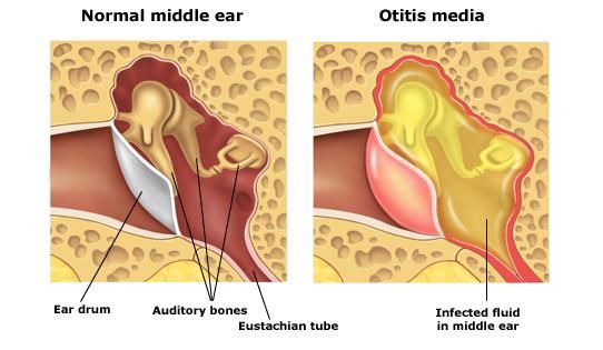 Glue Ear &  the Insertion of Grommets