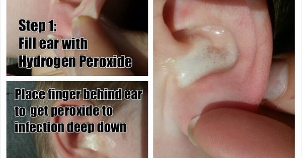 Good way to treat ear infections without antibiotics