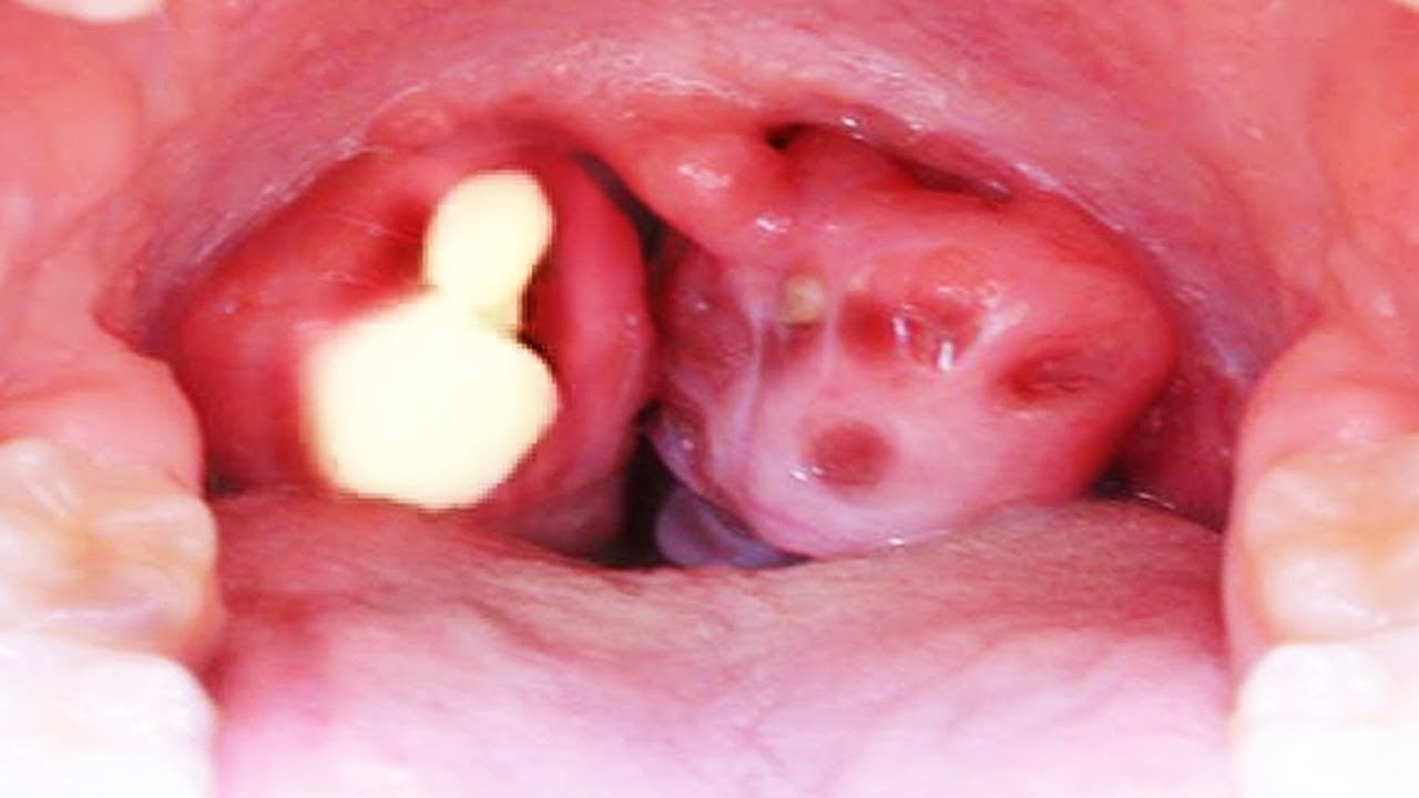 Halamang gamot sa tonsil