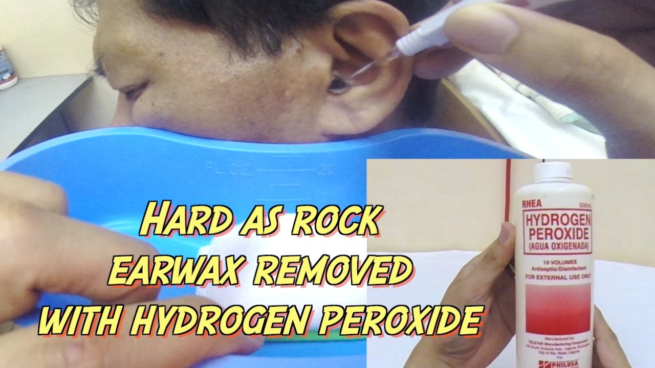 Hard as Rock Earwax Removal using Hydrogen Peroxide