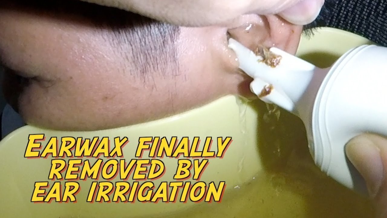 Hard Earwax Finally Removed by Ear Irrigation After 5 days ...
