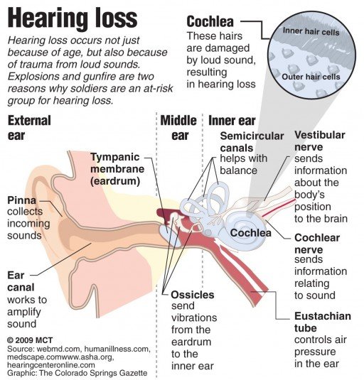 Hearing Loss. Causes, symptoms, treatment Hearing Loss