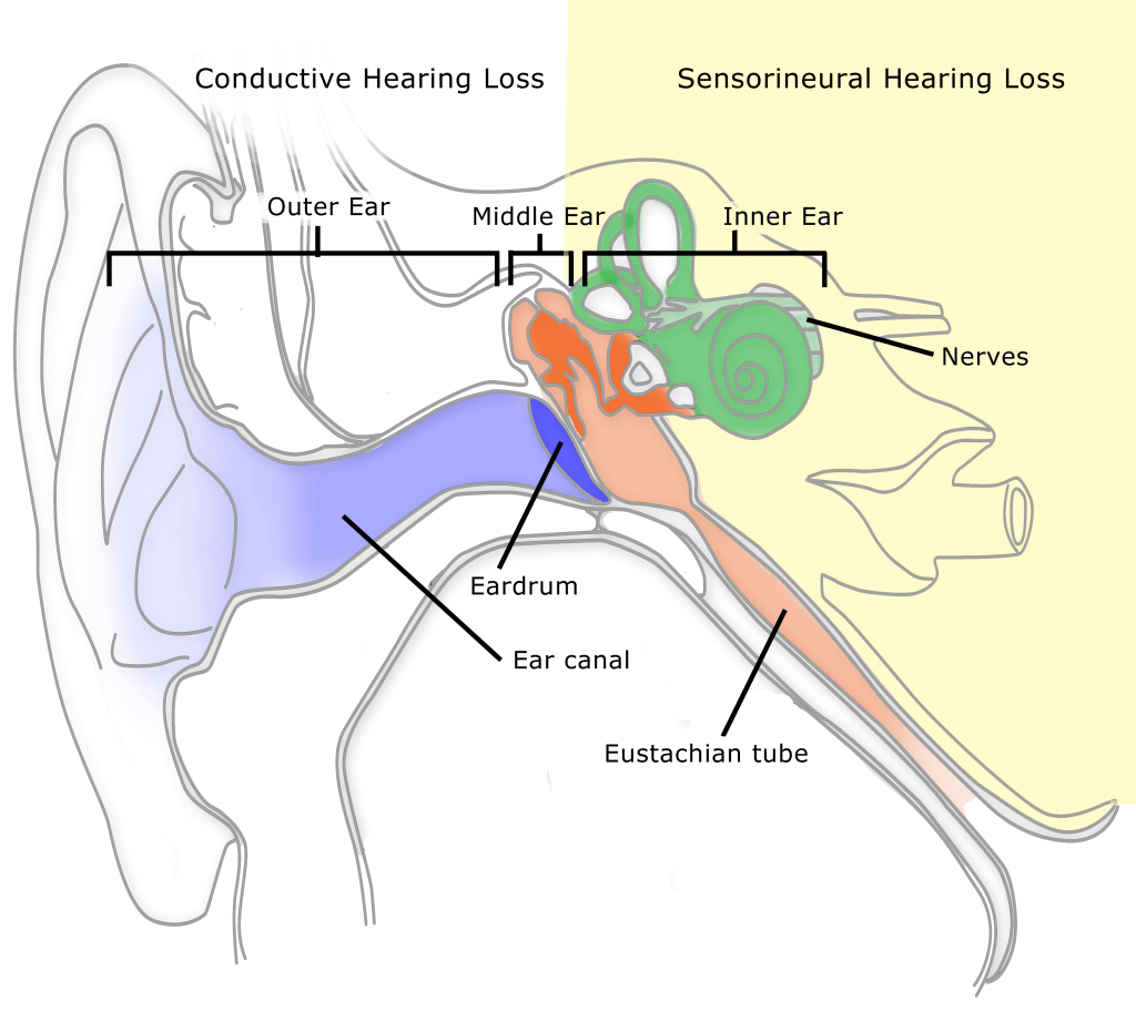 Sensorineural hearing loss. Sensorineural hearing loss treatment. Conductive hearing loss diagnosis.