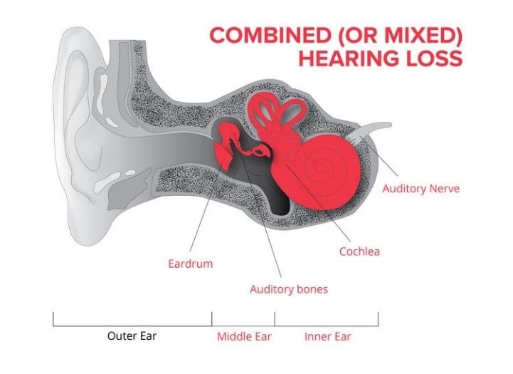 Hearing Loss Information &  Resources
