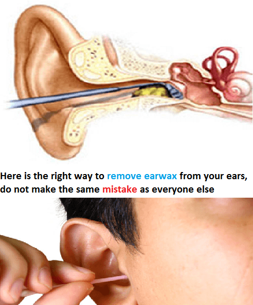 Here is the right way to remove earwax from your ears, do not make the ...