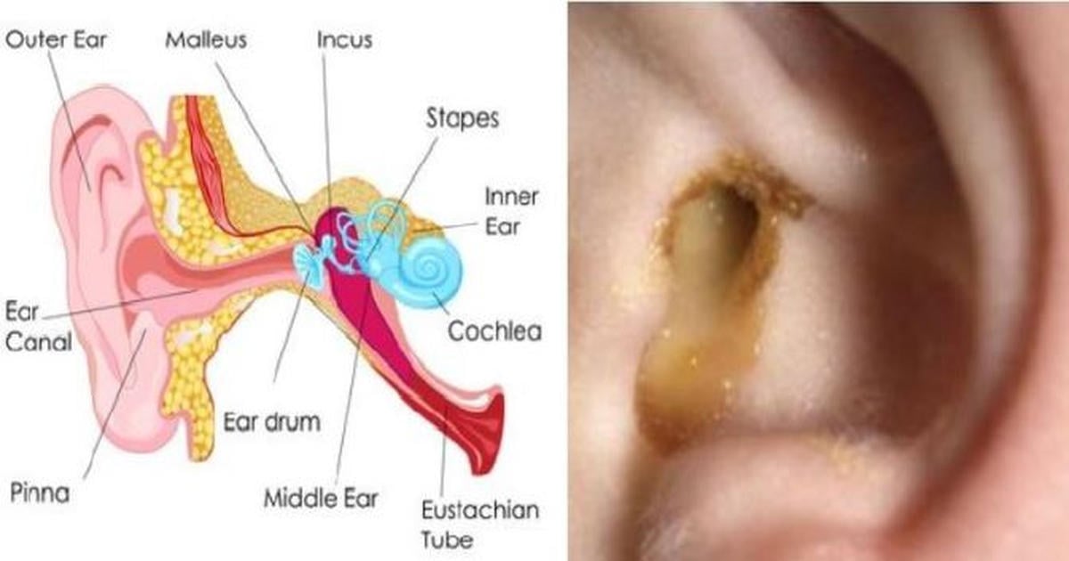 Home Remedies for Ear Infections : Human N Health