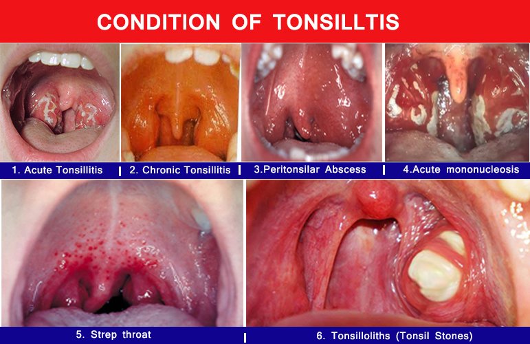 Homeopathy Medicine for Tonsillitis