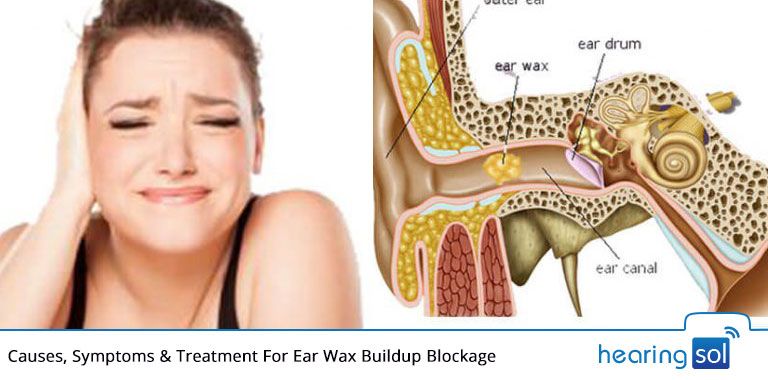 How do you get rid of earwax blockage at home