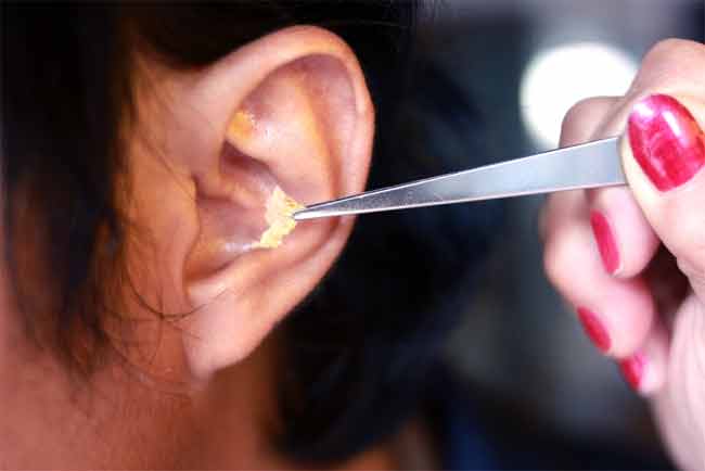 How Much does it Cost to get Earwax Removed?
