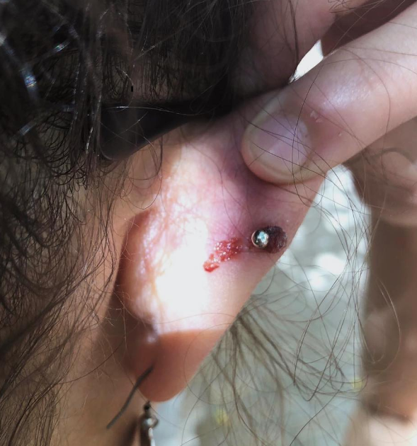 How To Cure An Infected Ear Piercing At Home