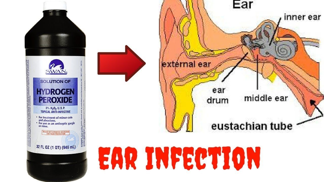 How to Get Rid of an Ear Infection with Hydrogen Peroxide ...