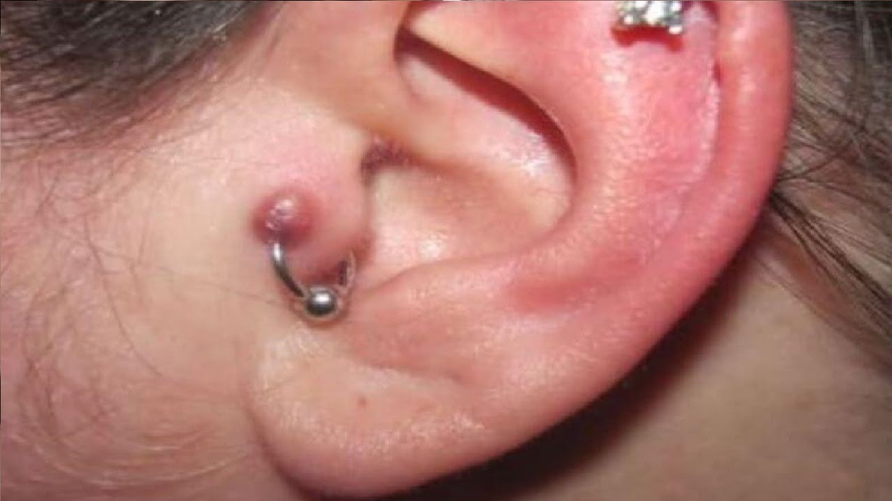 how to get rid of ear piercing infection fast