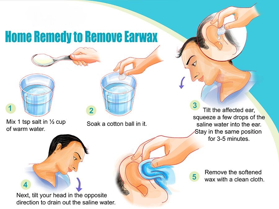 How to Get Rid of Ear Wax