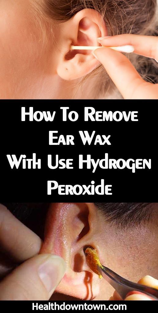 How To Remove Ear Wax With Use Hydrogen Peroxide en 2020 ...