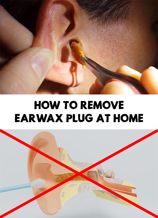 How To Remove Earwax Plug At Home