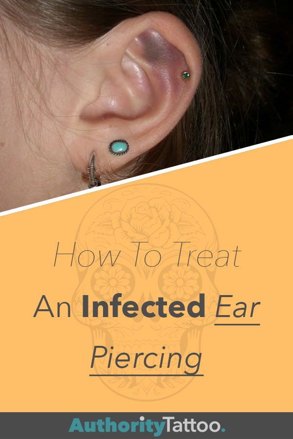 How To Treat An Infected Ear Piercing in 2020