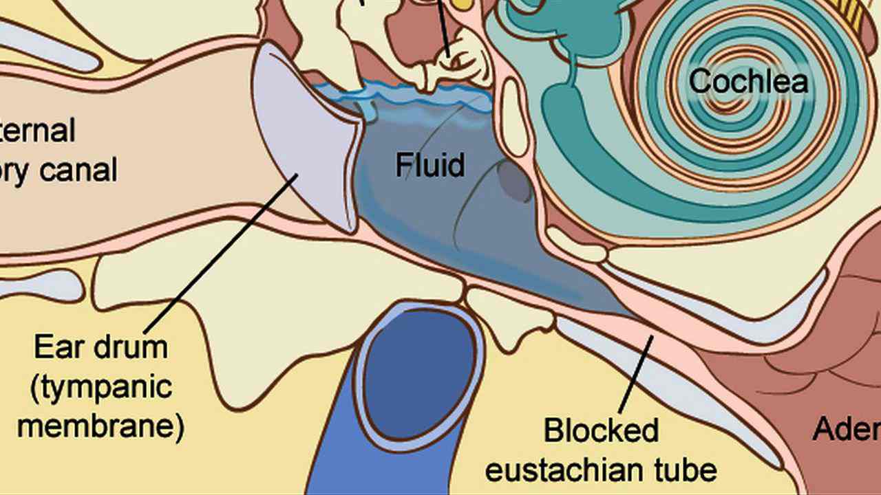 How to Treat Fluid in the Ear