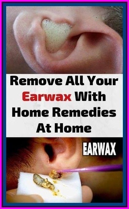 HOW TO USE HYDROGEN PEROXIDE TO REMOVE EAR WAX in 2021 ...